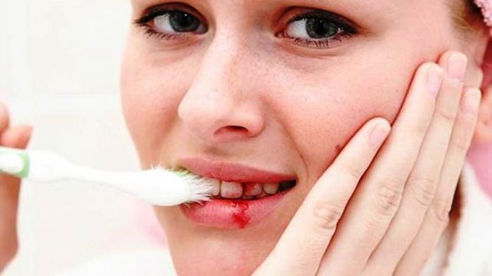 3 Cara Sederhana Yang Bisa Kamu Coba Untuk Mencegah Dan Mengatasi Gusi Berdarah